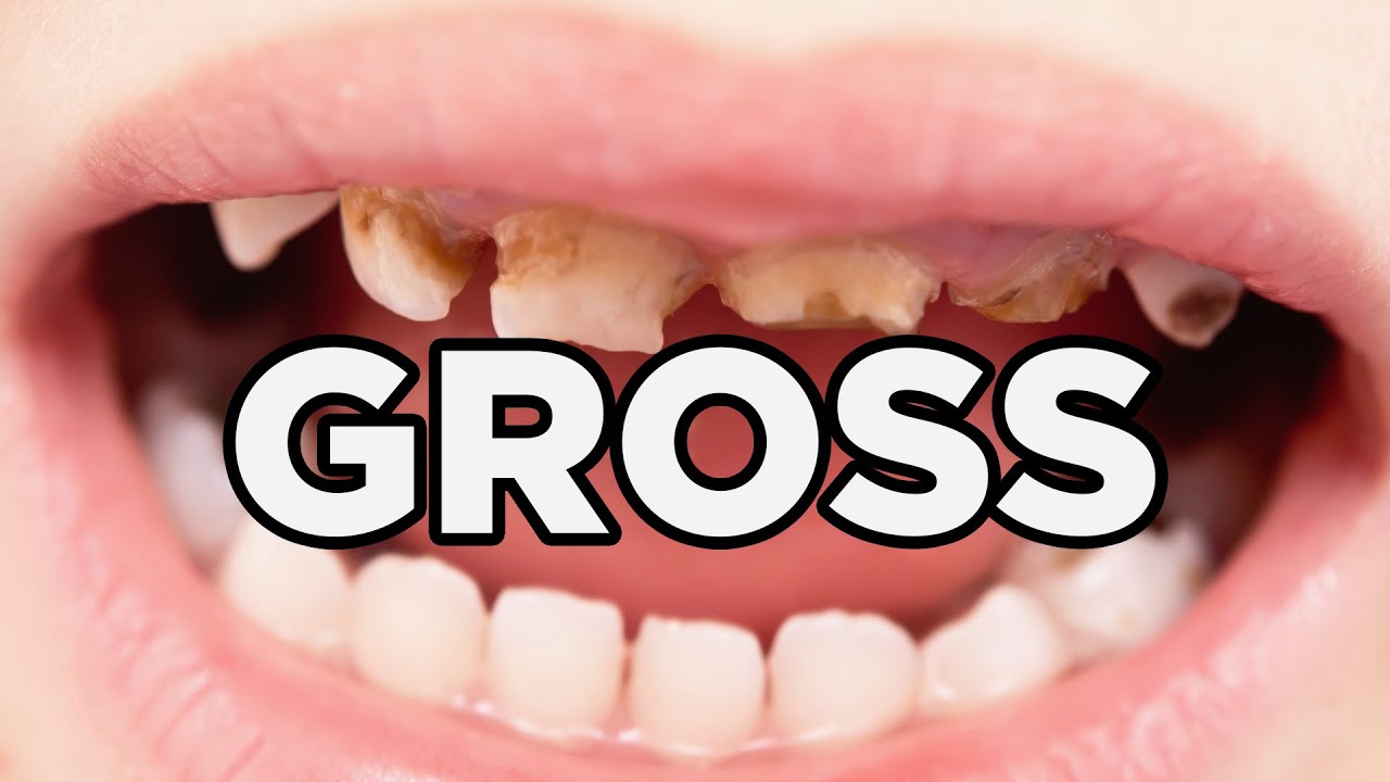 11 Gross Facts About Your Teeth
