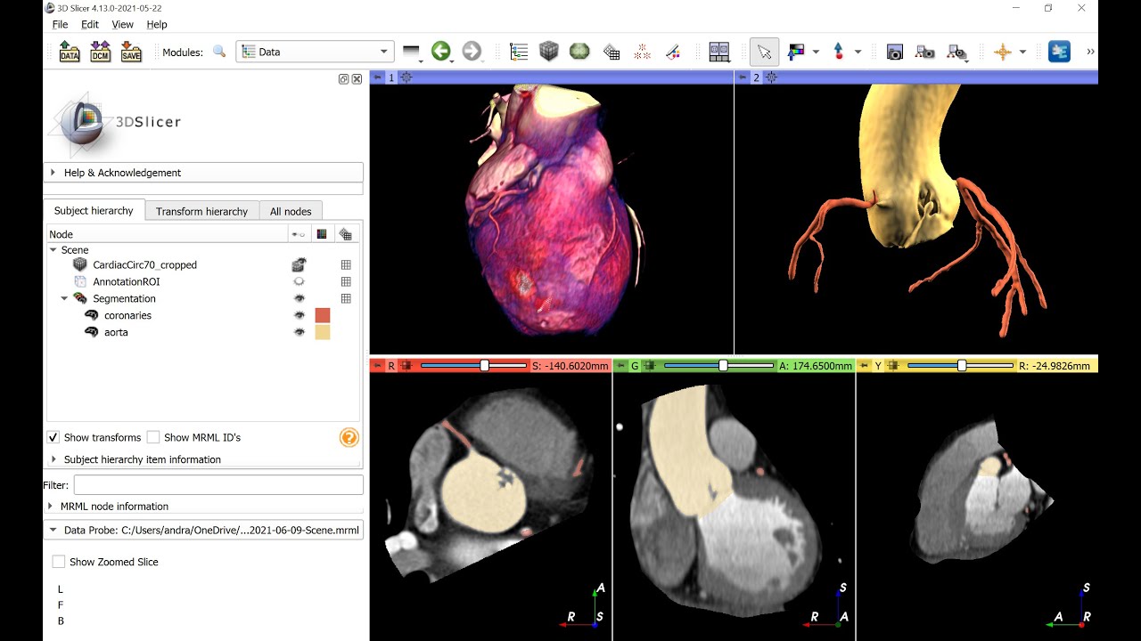 Coronary vessel segmentation on cardiac CT images