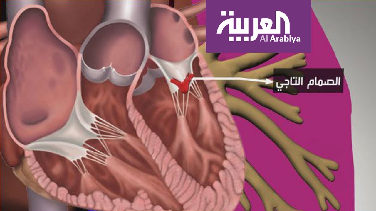 صباح العربية | تقنية جديدة بدل عمليات القلب المفتوح