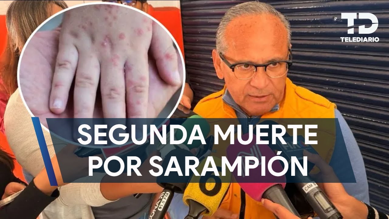 Confirman segunda muerte por sarampión en Jalisco