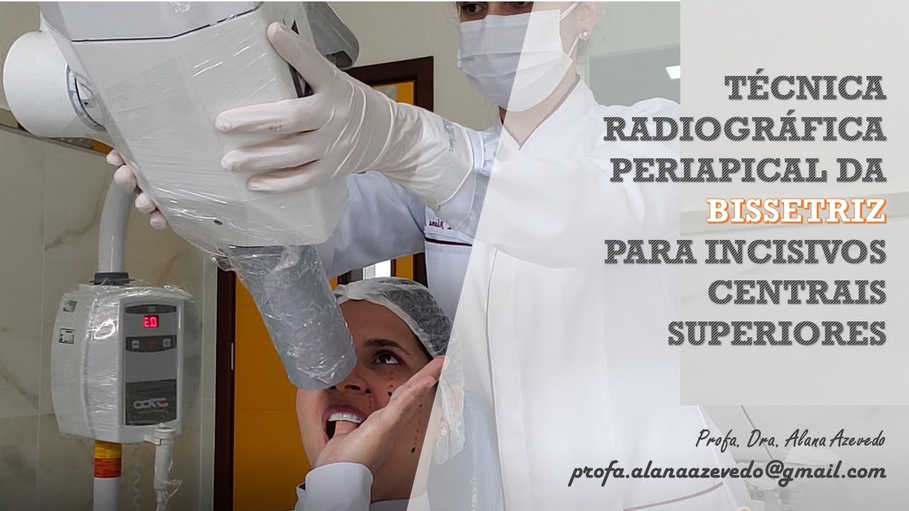 Técnica radiográfica periapical da bissetriz para incisivos centrais superiores.