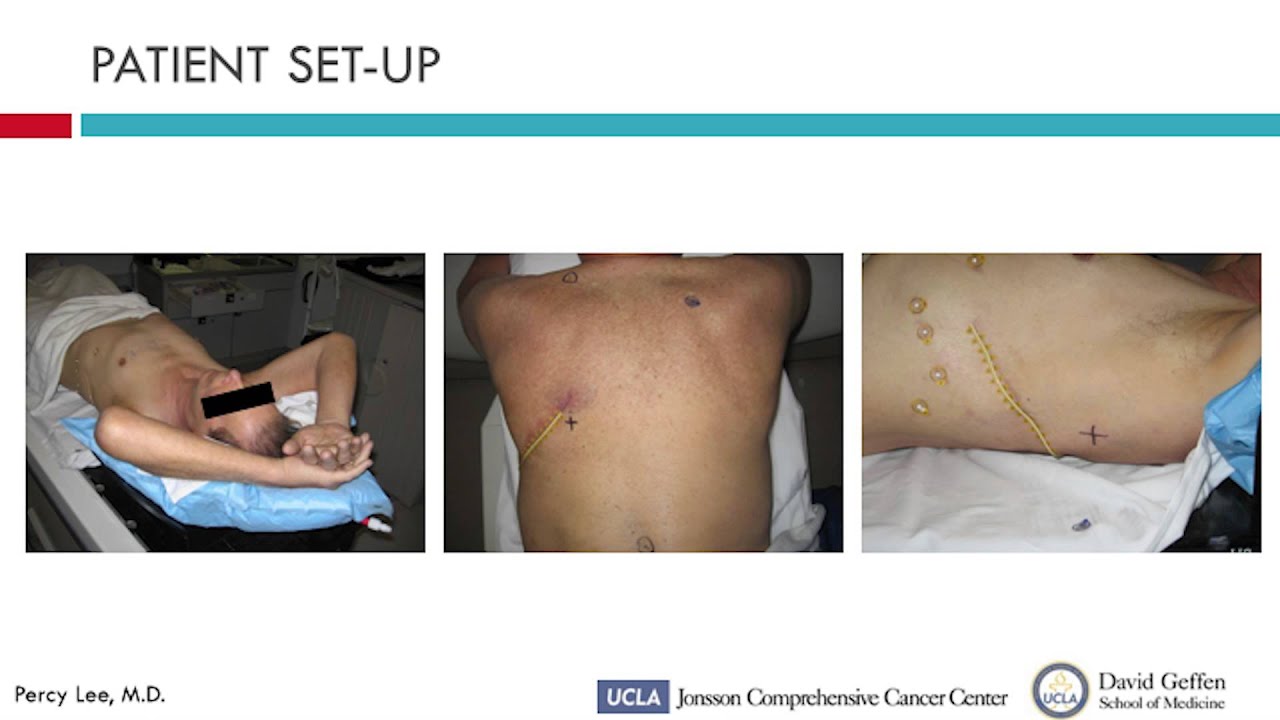 Postoperative Tomotherapy: Tissue Targeting and Toxicity