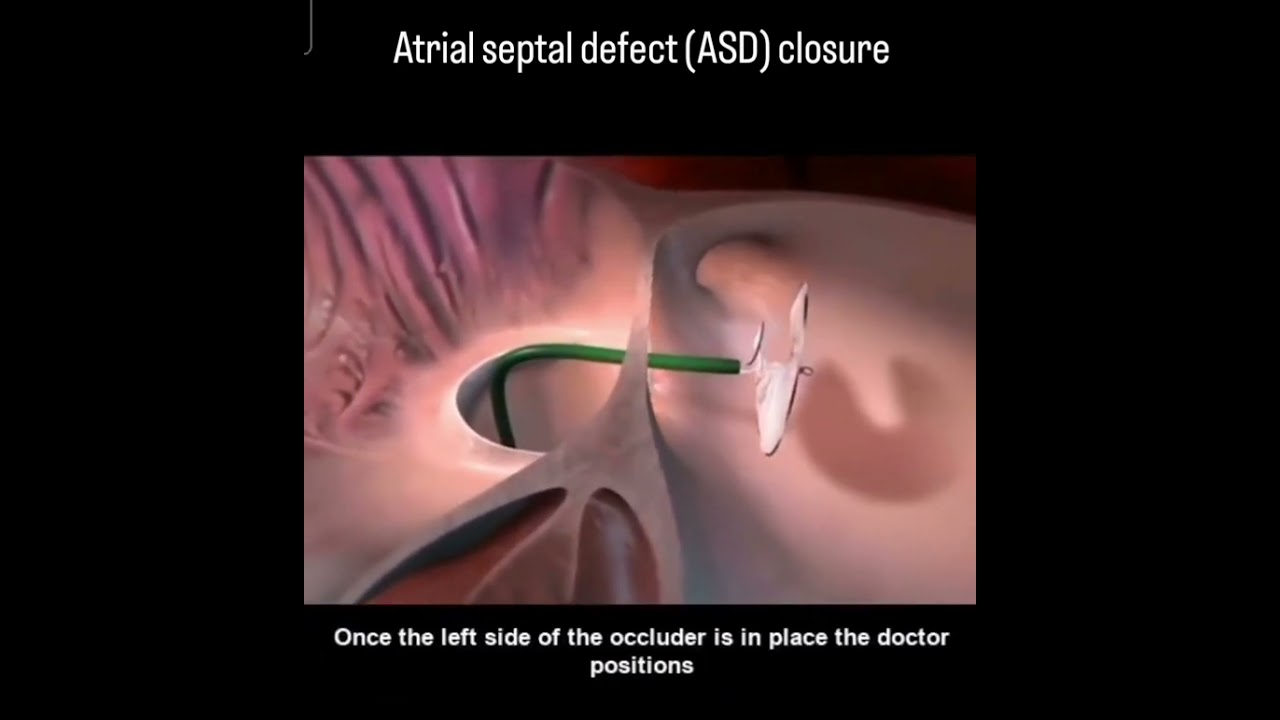 Atrial septal defect (ASD) closure with the helex septal occluder.