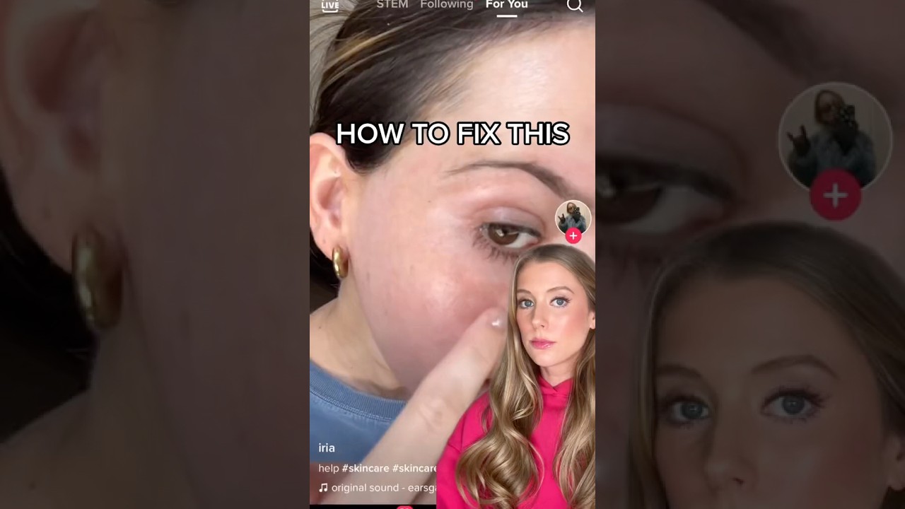 How to get rid of dark spots / sun spots / melasma!