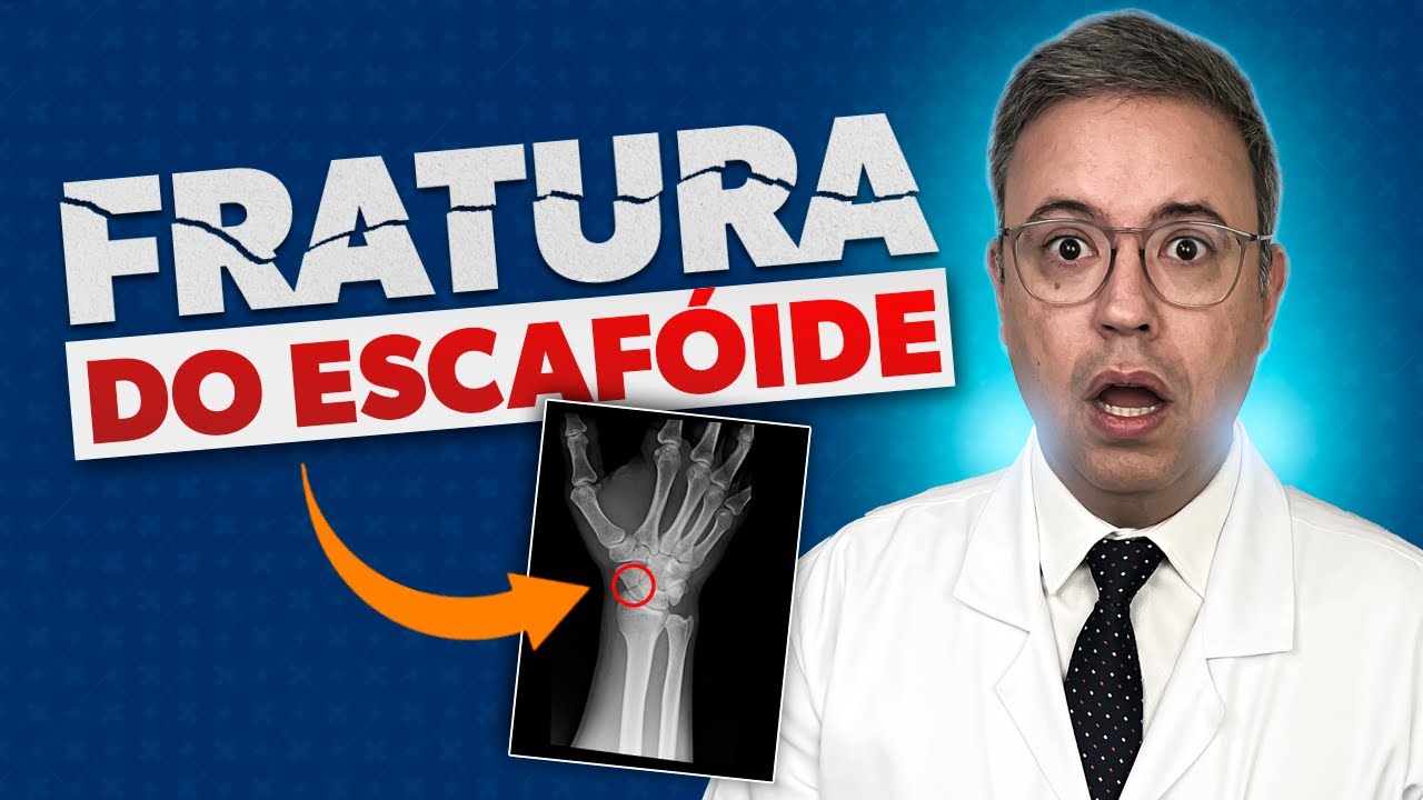 Fratura do Escafóide
