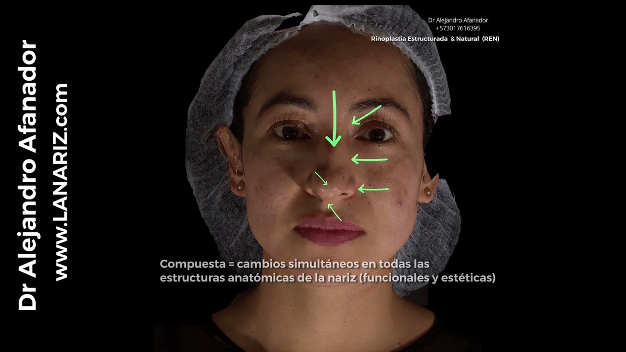 Rinoplastia Estructurada & compuesta