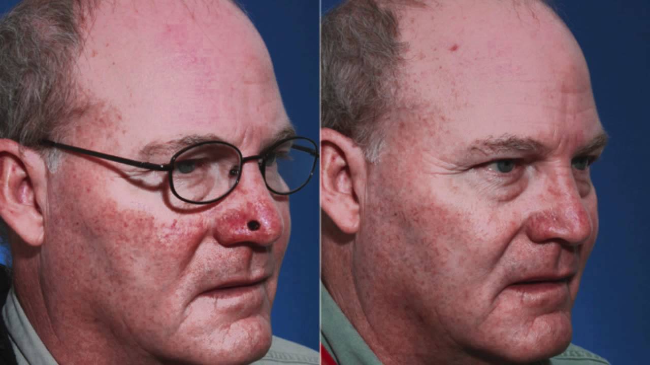 Nasal Reconstruction After MOHS Surgery