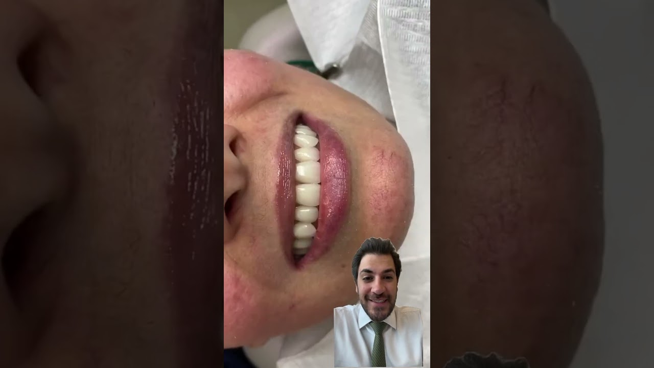 Prótese fixa sob implante