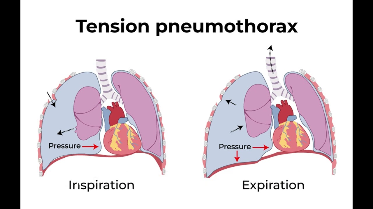 needle decompression
