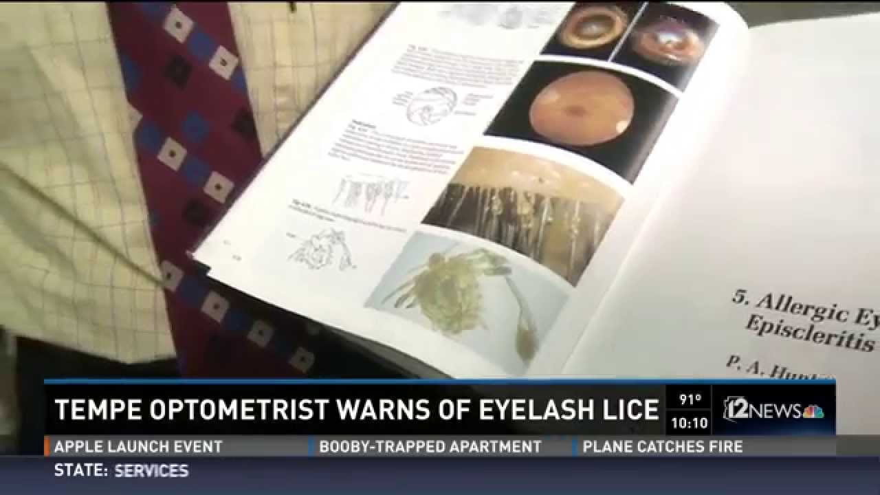 Warnings About Eyelash Lice