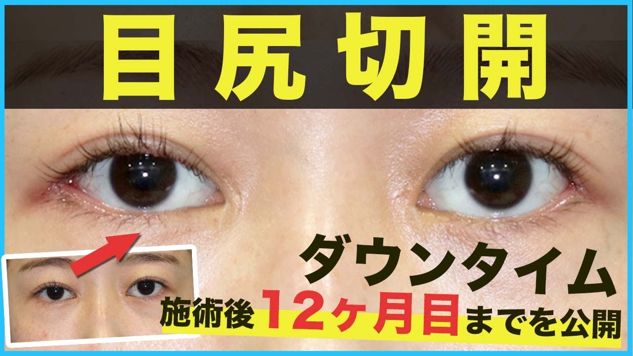 【目尻切開】傷跡は目立つ？後戻りするの？目尻切開のダウンタイムついて解説【目の整形】