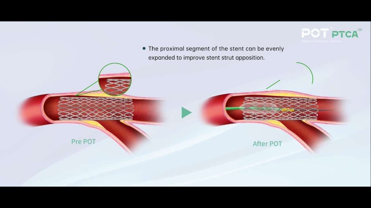 BrosMed POT PTCA Balloon Dilatation Catheter