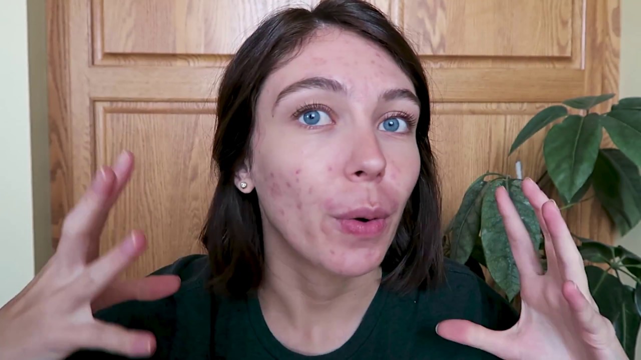 Why I Stopped Accutane (Plus My Acne Story)