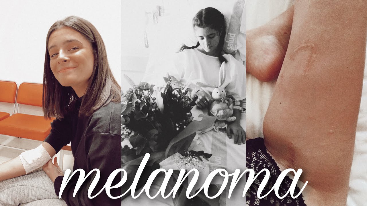 mi historia frente al melanoma | mi experiencia | @luciagamisel