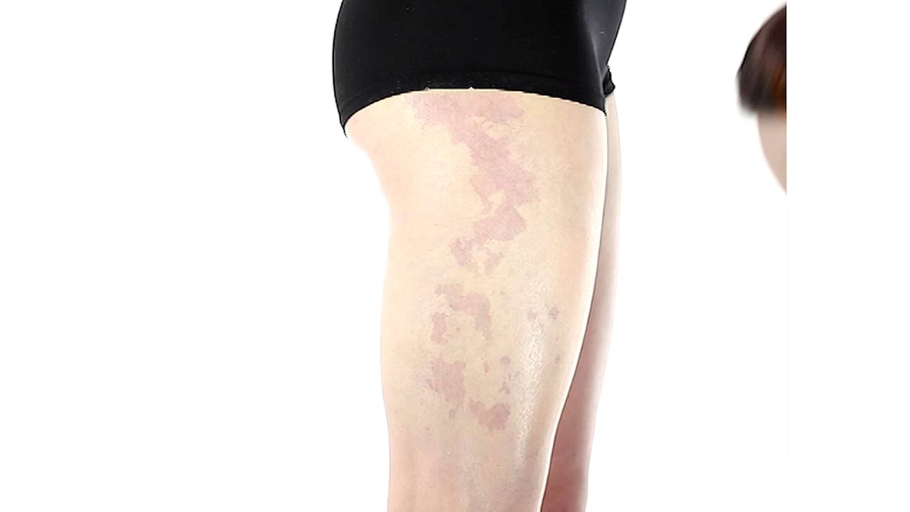 How to Cover a Birthmark with Skin Camouflage Makeup