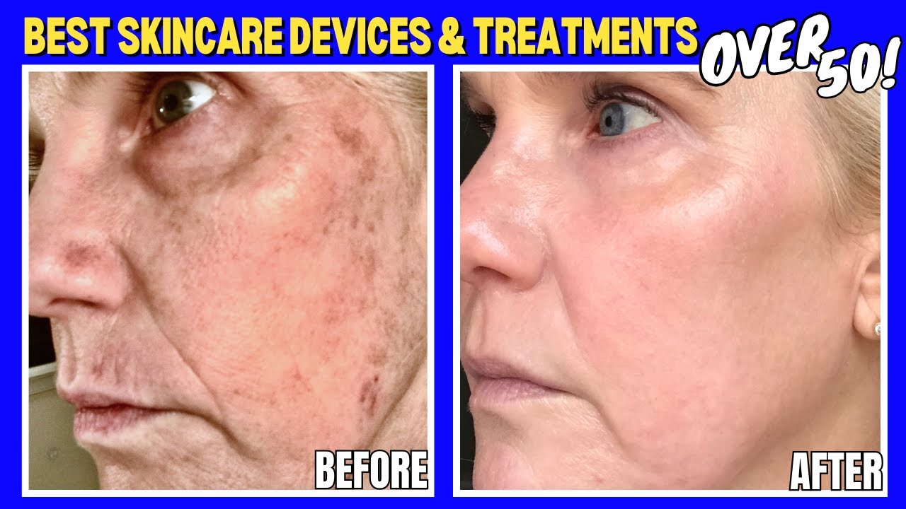 Best Skincare Treatments to Transform Mature Skin (Top 3 Devices & Top 3 In-Office Treatments)