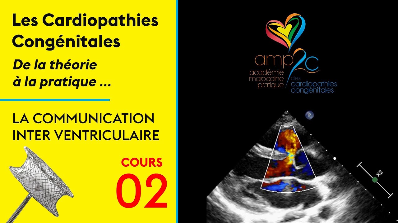 Cours et cas cliniques :  Les CIV ( Communications Inter Ventriculaires )