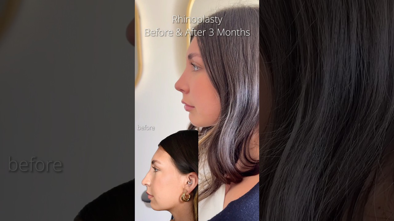 STUNNING RESULTS 3 Months post nose job! WOW 