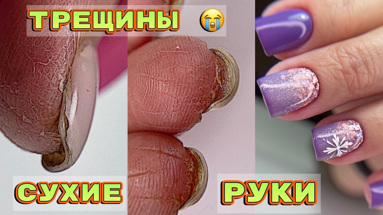 Трещины на пальцах 💅 Особенности работы с сухими руками 💅 Маникюр