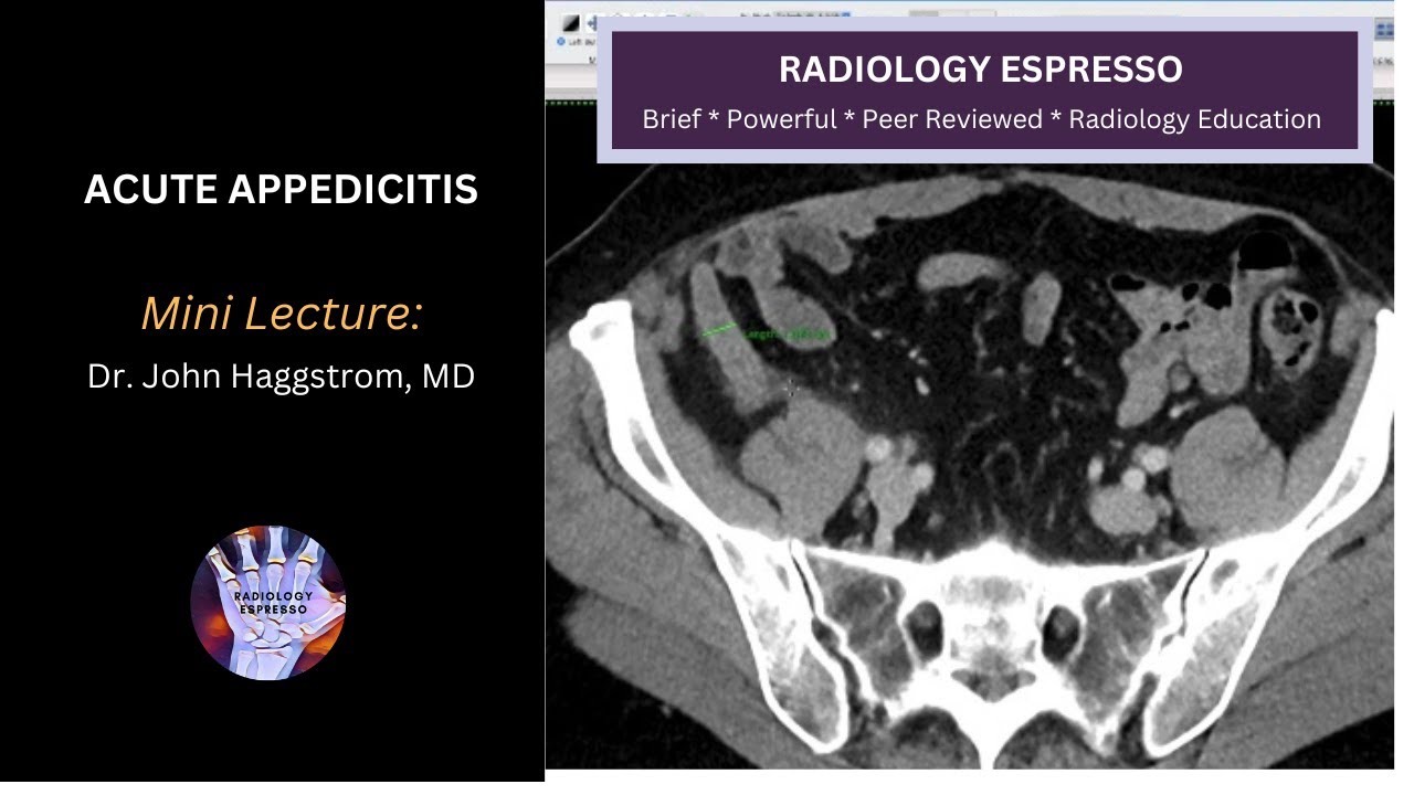 ACUTE APPENDICITIS: Mini Lecture, Dr. John Haggstrom, MD