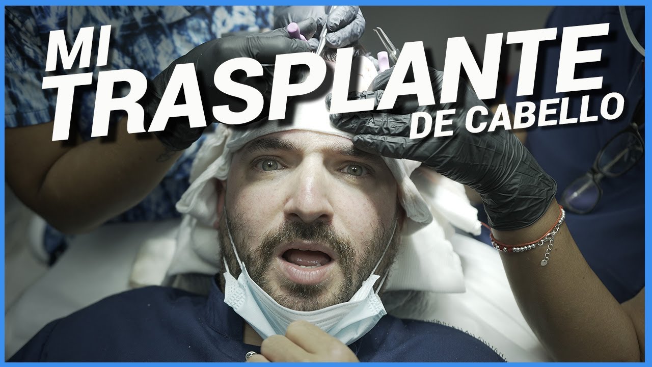 CÓMO ES UN TRASPLANTE DE CABELLO! EL MIO!!!