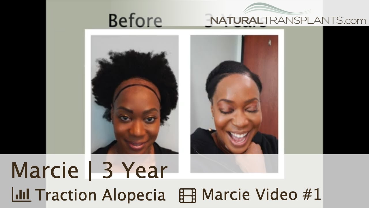 Traction Alopecia Regrowth: Patient Checks In After 3 Years | Dr. Siegel (Marcie)