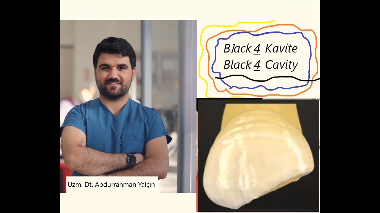 2. Sınıf Preklinik Black 4 Kavite /sınıf 4 kavite /Black 4 cavity