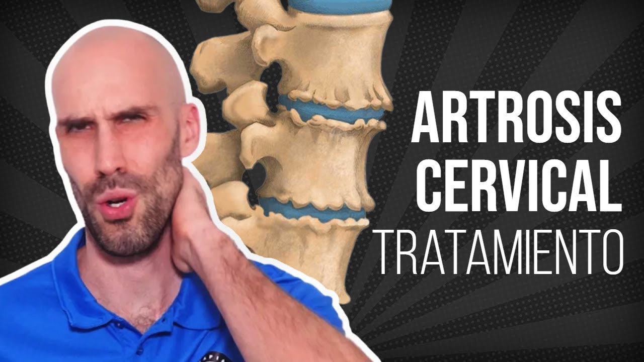ARTROSIS CERVICAL, ejercicios, masaje y estiramientos para ALIVIAR EL DOLOR