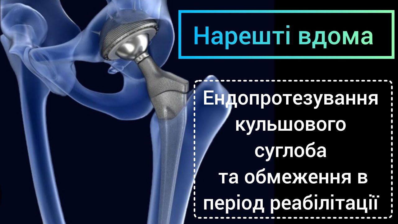 Нарешті вдома. Ендопротезування кульшового суглоба та обмеження в період реабілітації.