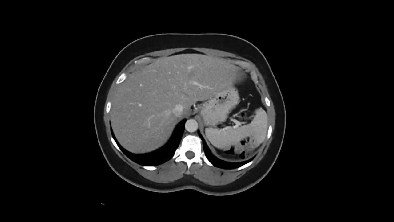 Retroperitoneal Leiomyosarcoma