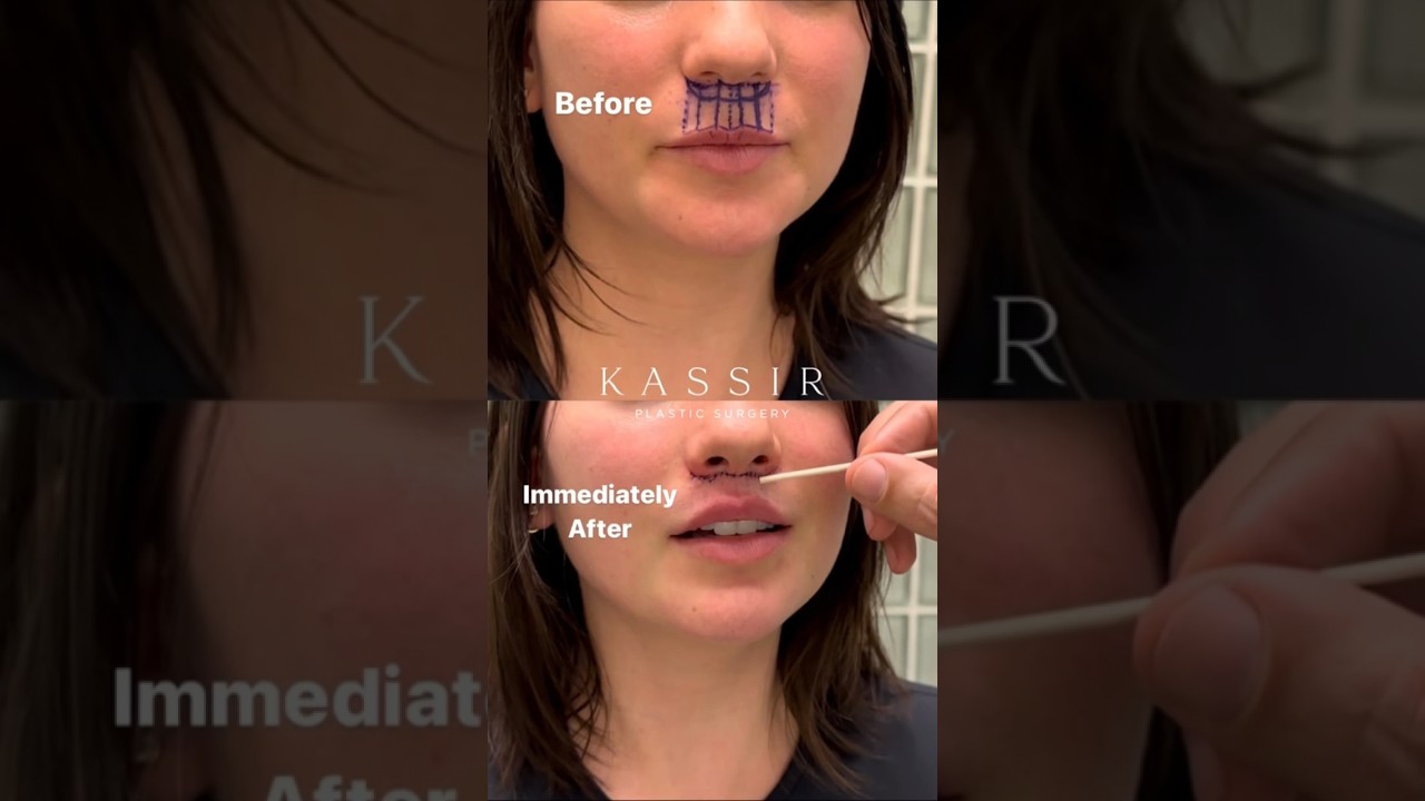 Lip Lift #liplift #nycliplift #lipliftnyc #njliplift #lipflip #lipliftbeforeandafter #plasticsurgery