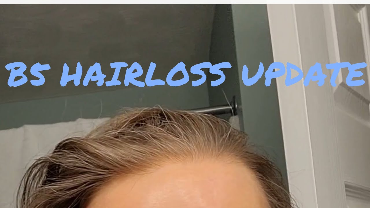 UPDATE: Vitamin-B5-Aggravated Hairloss Treatment that is WORKING! 🎉 🥳