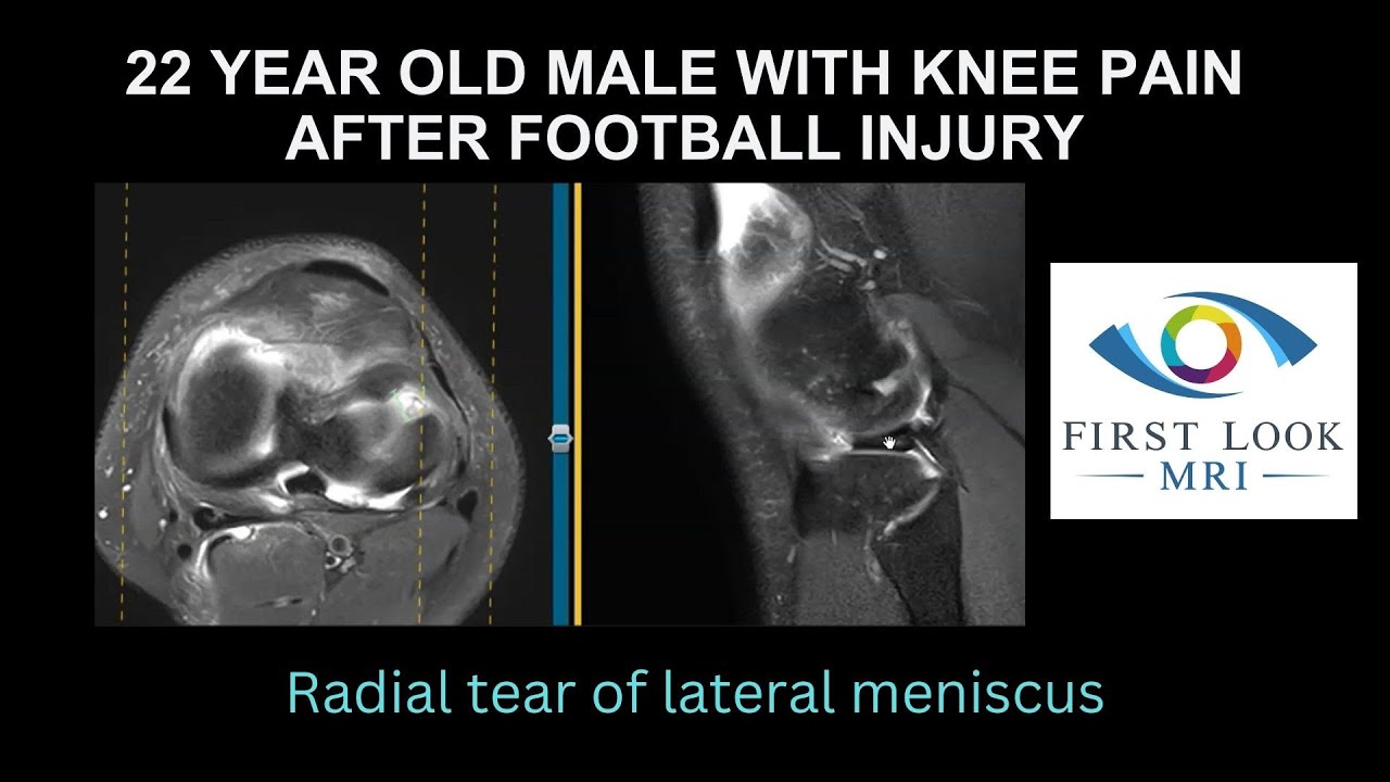 22 year old male with knee pain after football injury