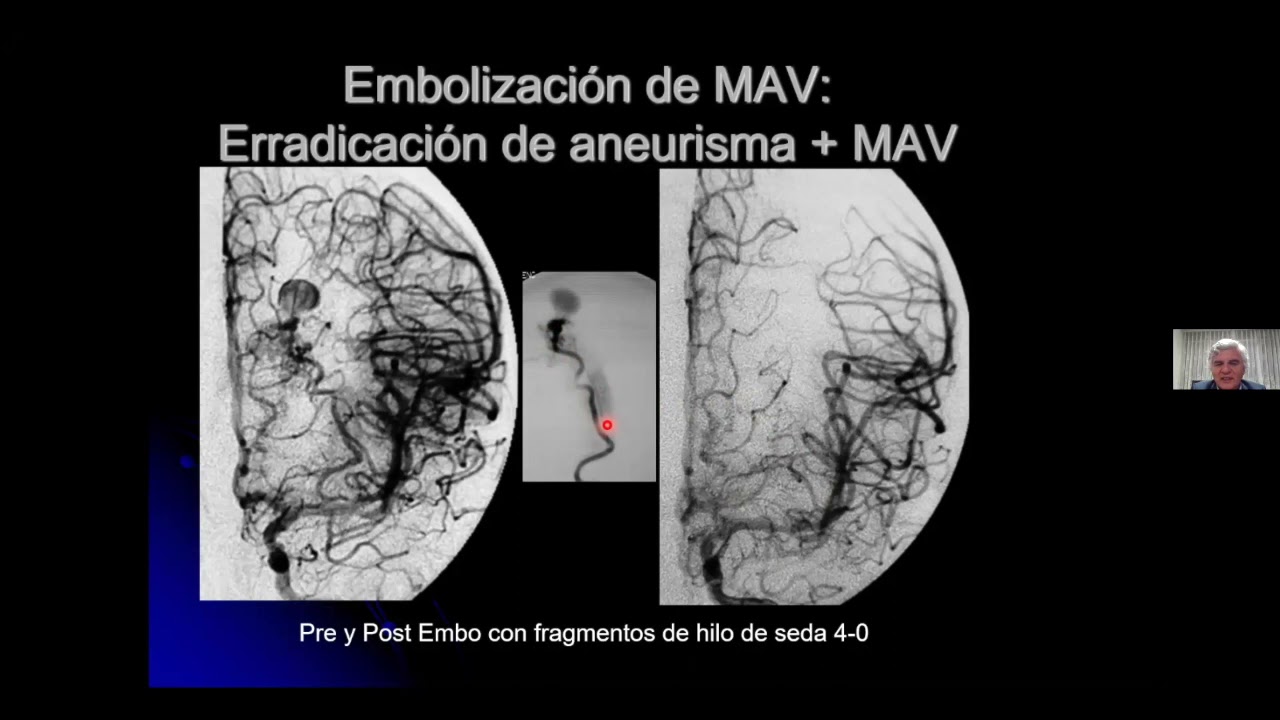 Embolización y Radiocirugía en el manejo de las MAV's