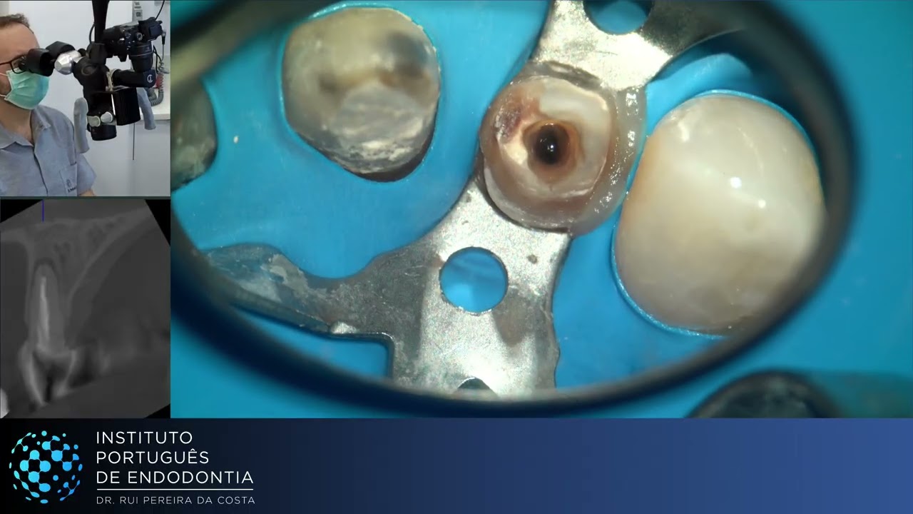 Rtx of 🦷 21 & 22 with Fiber 🔩 | AAP ▶️ Single Session | CASE333