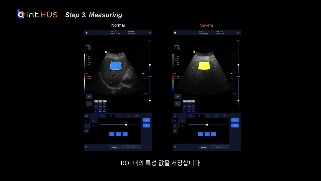 Quantitative Ultrasound of Barreleye