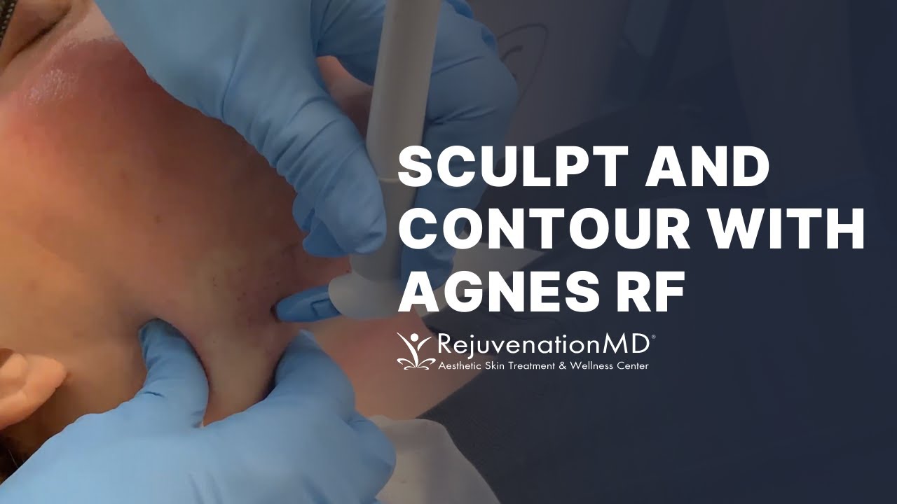 Eliminate Stubborn Fat Permanently with Agnes RF!