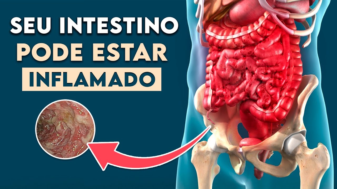 INTESTINO INFLAMADO: Sintomas de Doença Inflamatória Intestinal │ Doença de Crohn