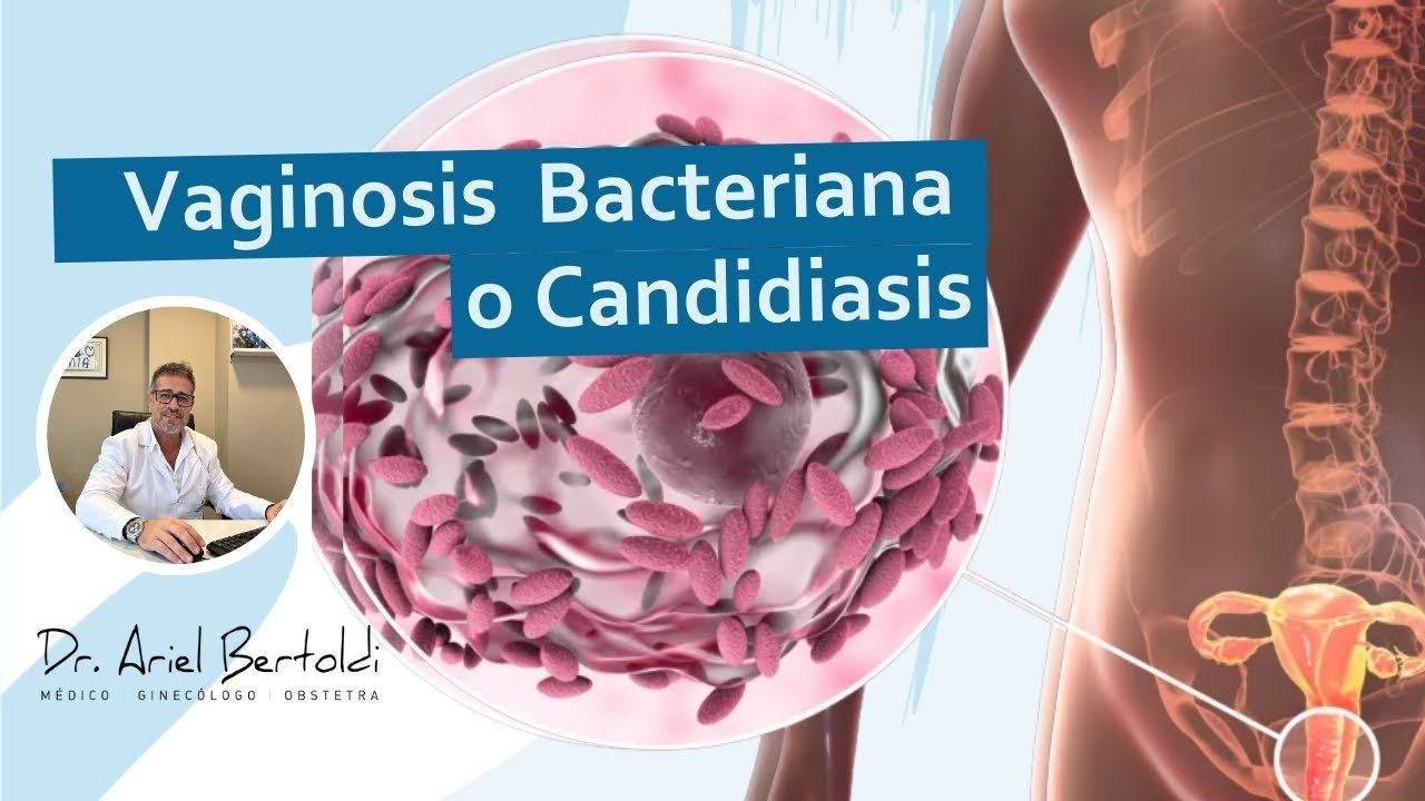 ¿Candidiasis, Vaginosis o Vulvovaginitis?