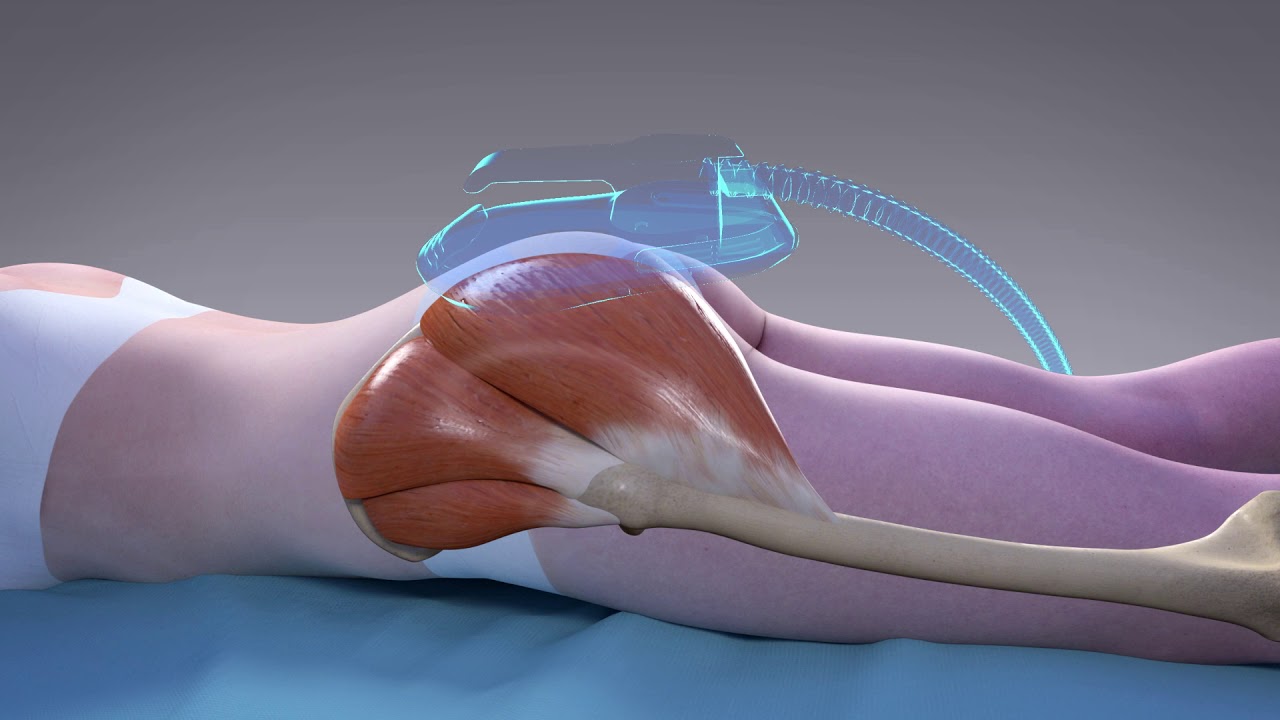 How it Works: Non-Surgical Butt Lift with EMSculpt | The Cosmetic Skin Clinic