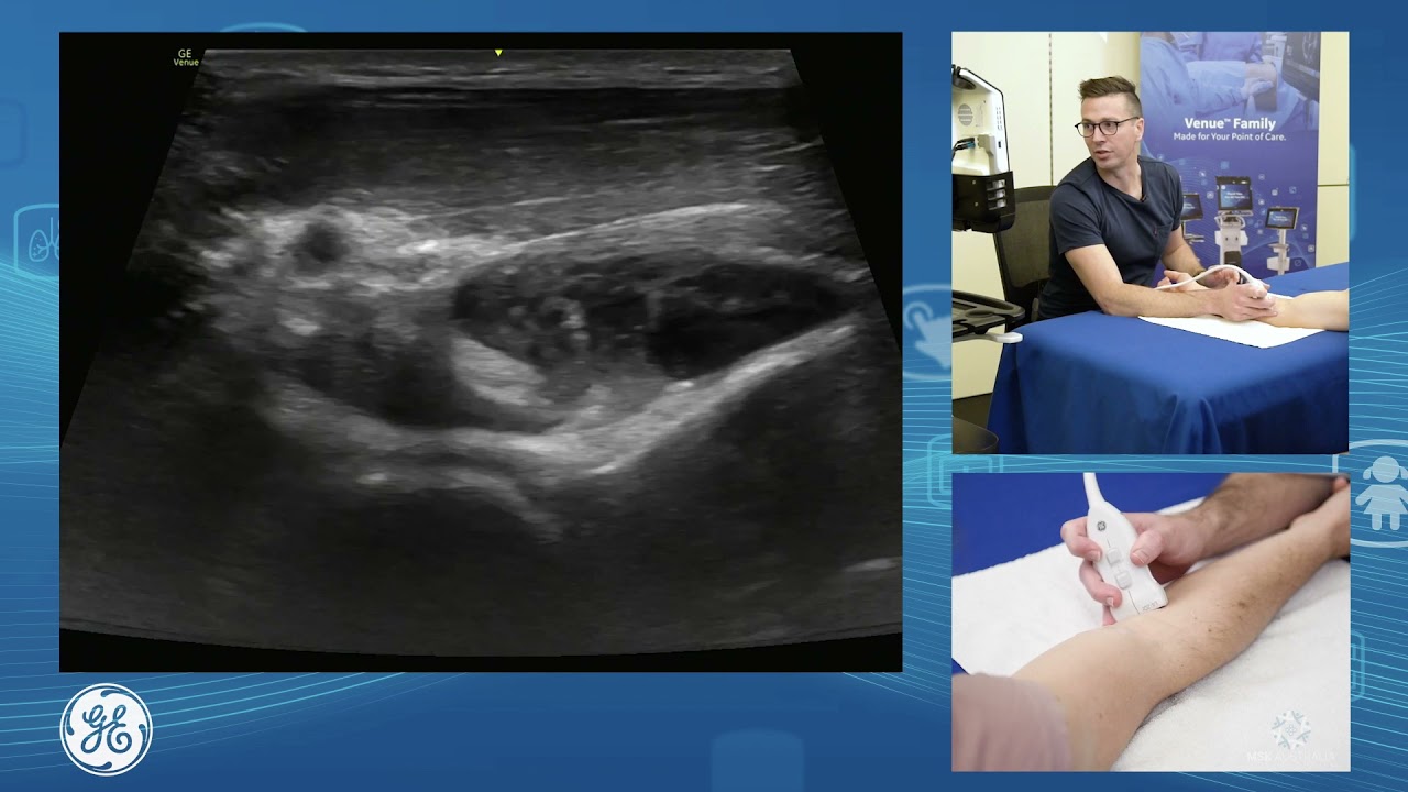 Sonographic assessment of the biceps brachii for POCUS clinicians