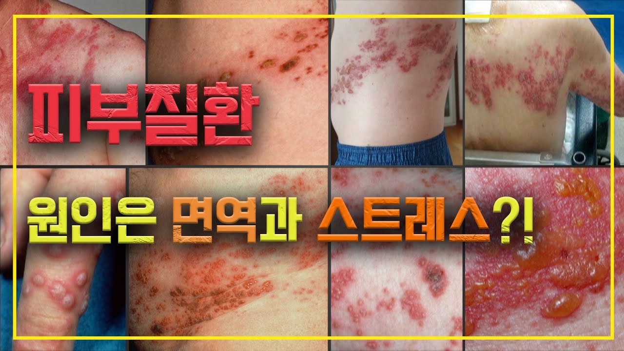 피부질환 원인은 면역과 스트레스?! | 피부질환 |  명의 | #EBS건강