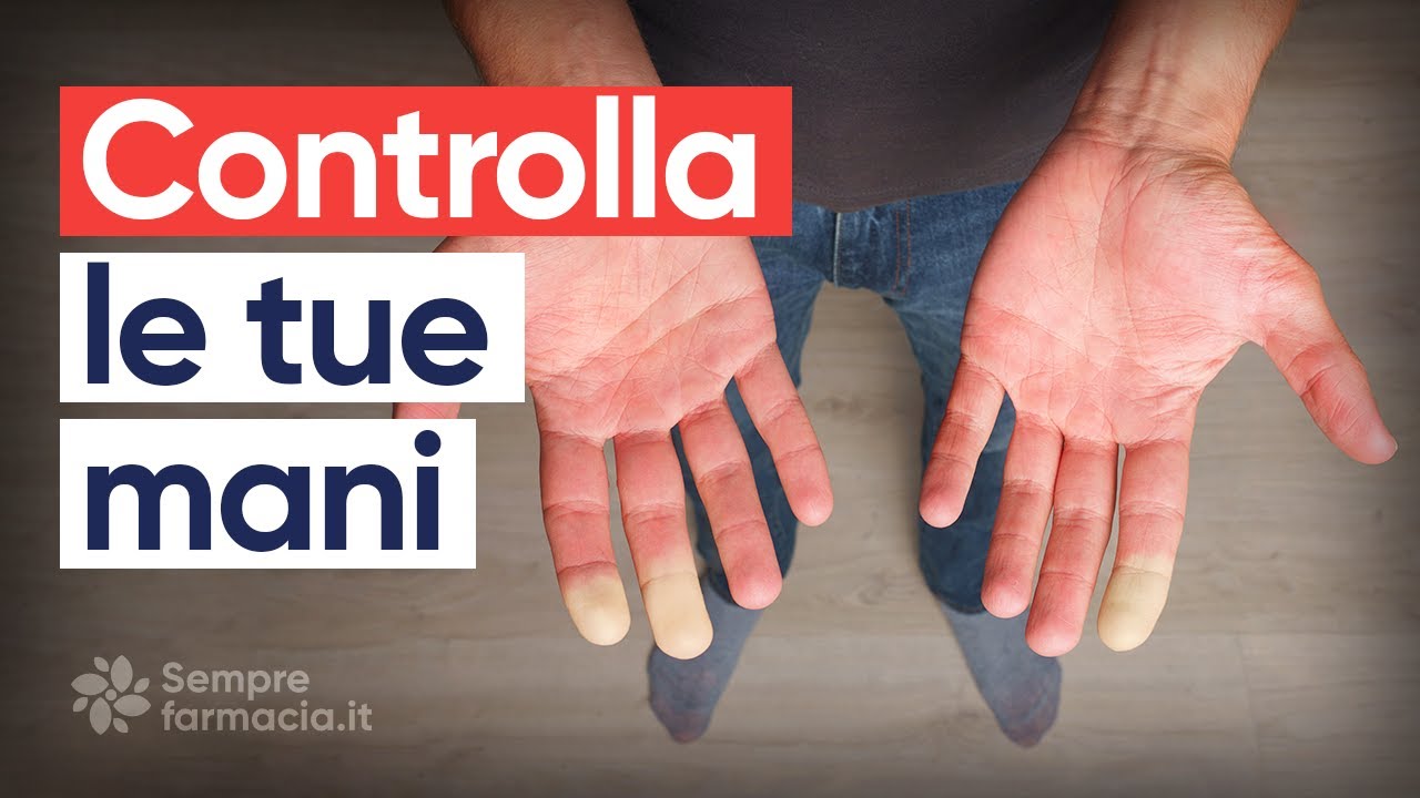 Sindrome di Raynaud: sintomi e cura