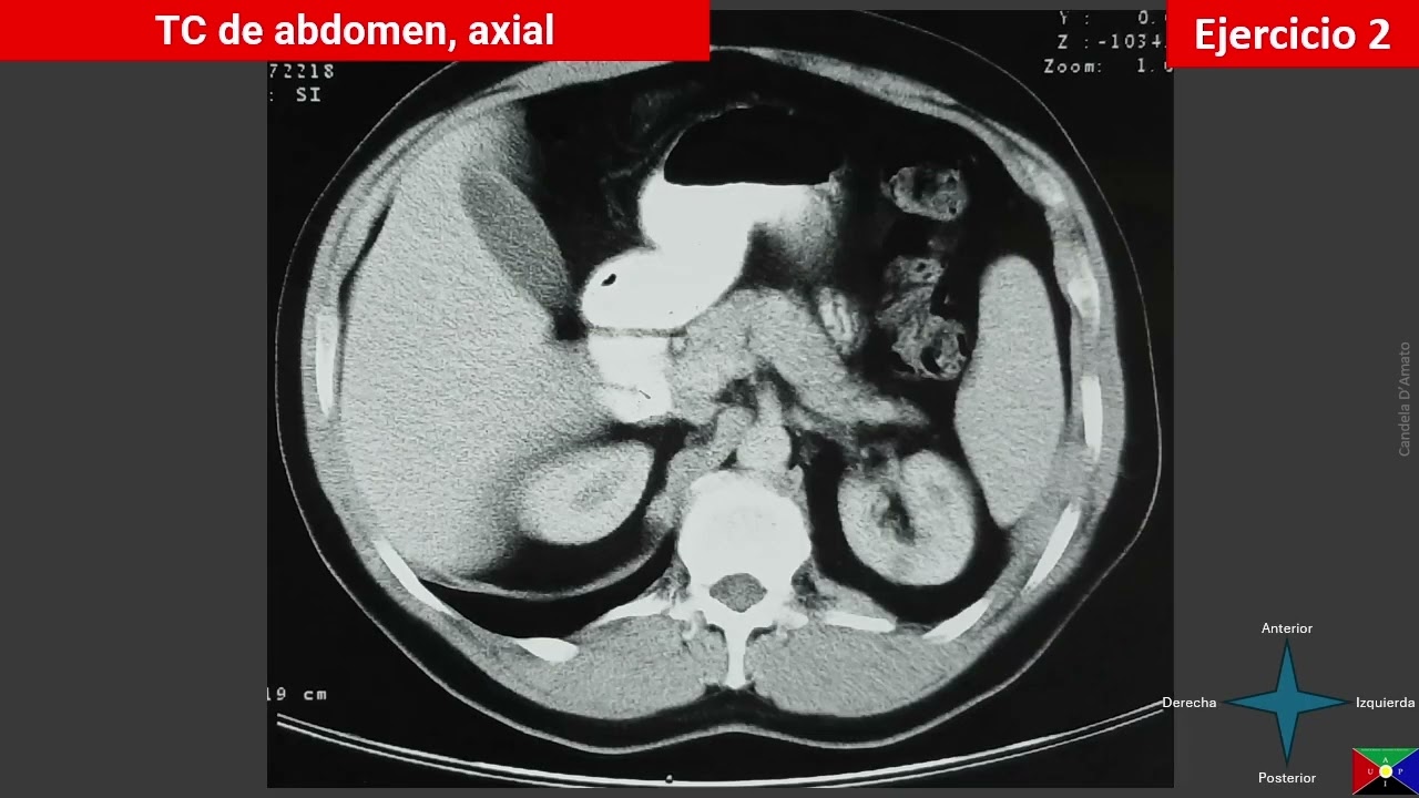 Tomografía computada de abdomen supramesocólico - parte B