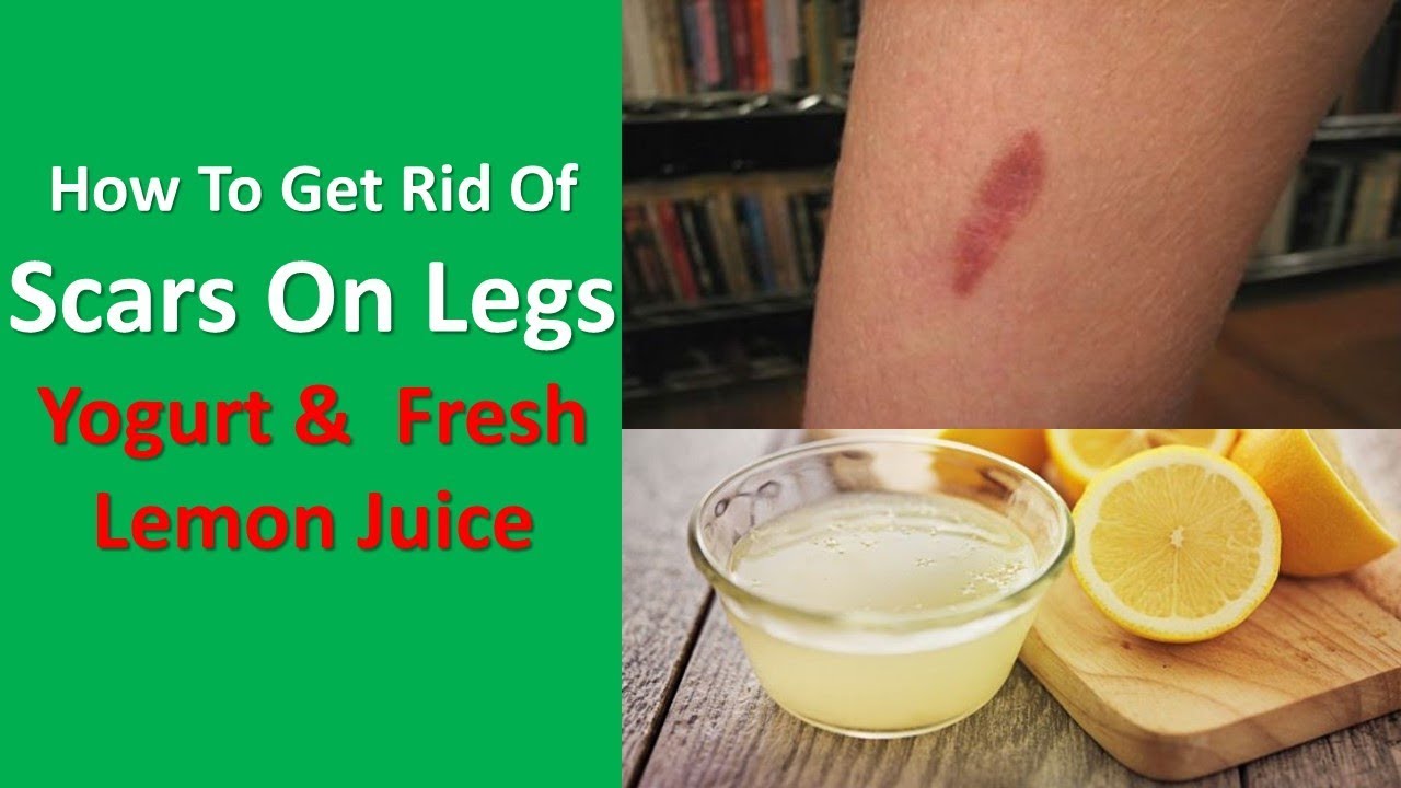 How To Get Rid Of Scars On Legs Naturally With Home Remedies With Yogurt &  Fresh Lemon Juice