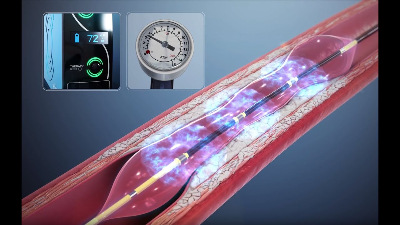 Shockwave Therapy