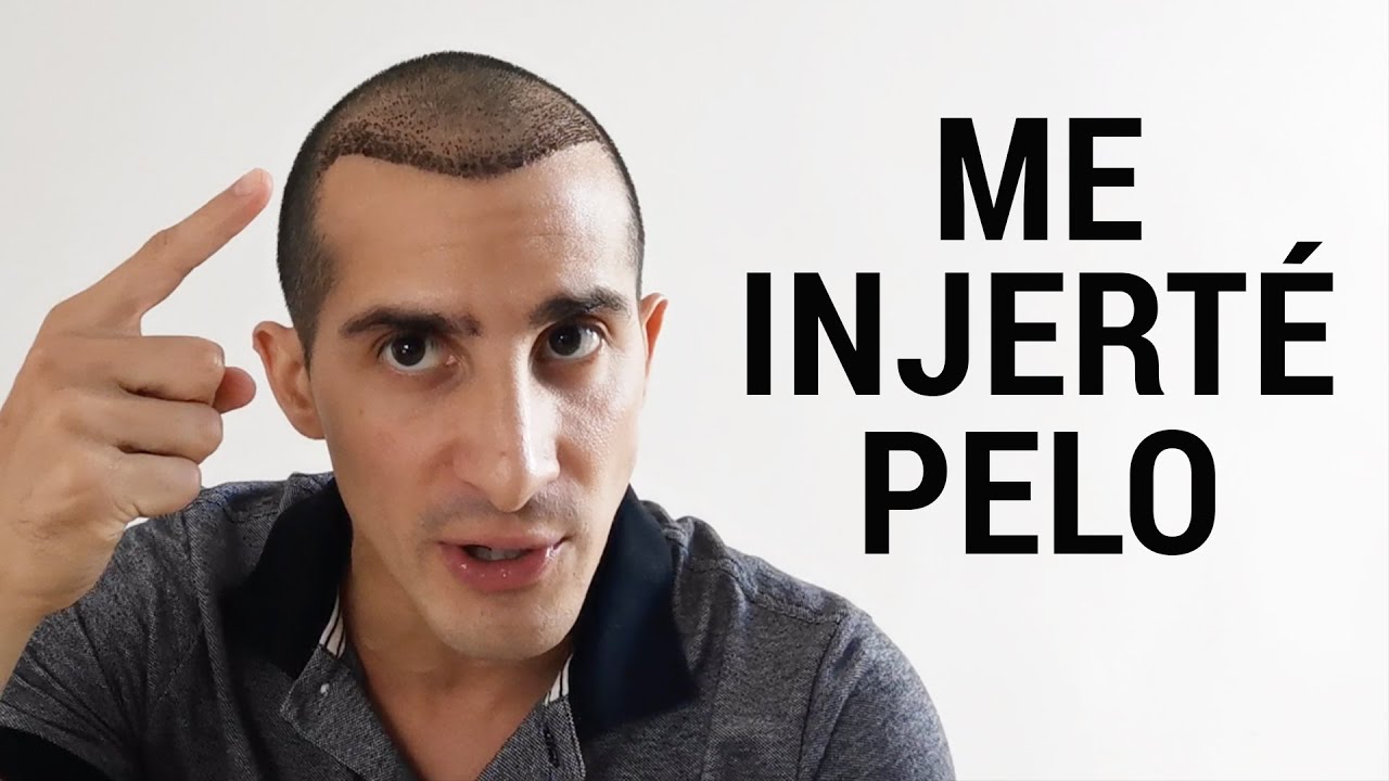 Me injerté pelo | Mitos y realidades | Rommel Pacheco
