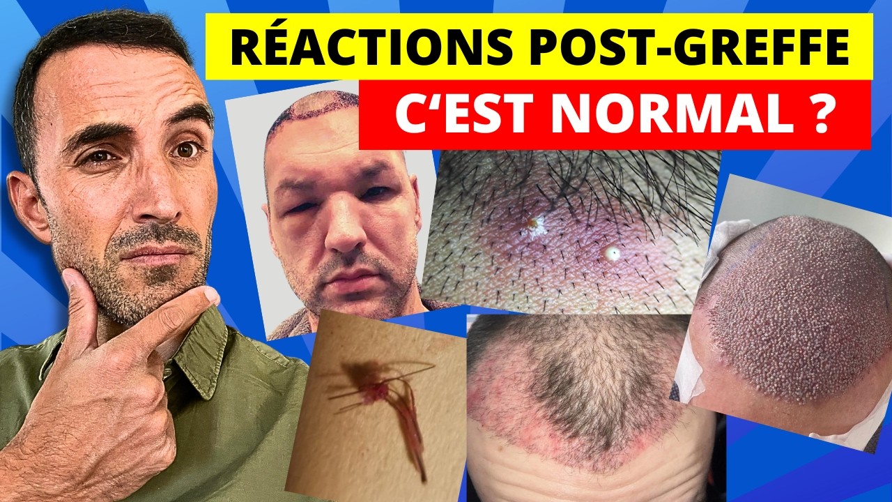 Ça se passe après ta greffe de cheveux 😱 - T’inquiète c’est normal !