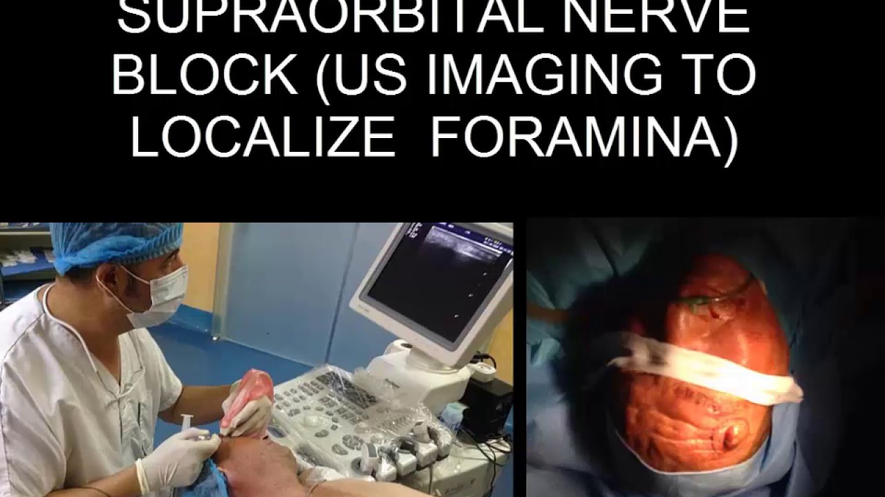ULTRASOUND GUIDED SUPRAORBITAL NERVE BLOCK ULTRASOUND IMAGING TO LOCALIZE  FORAMINA