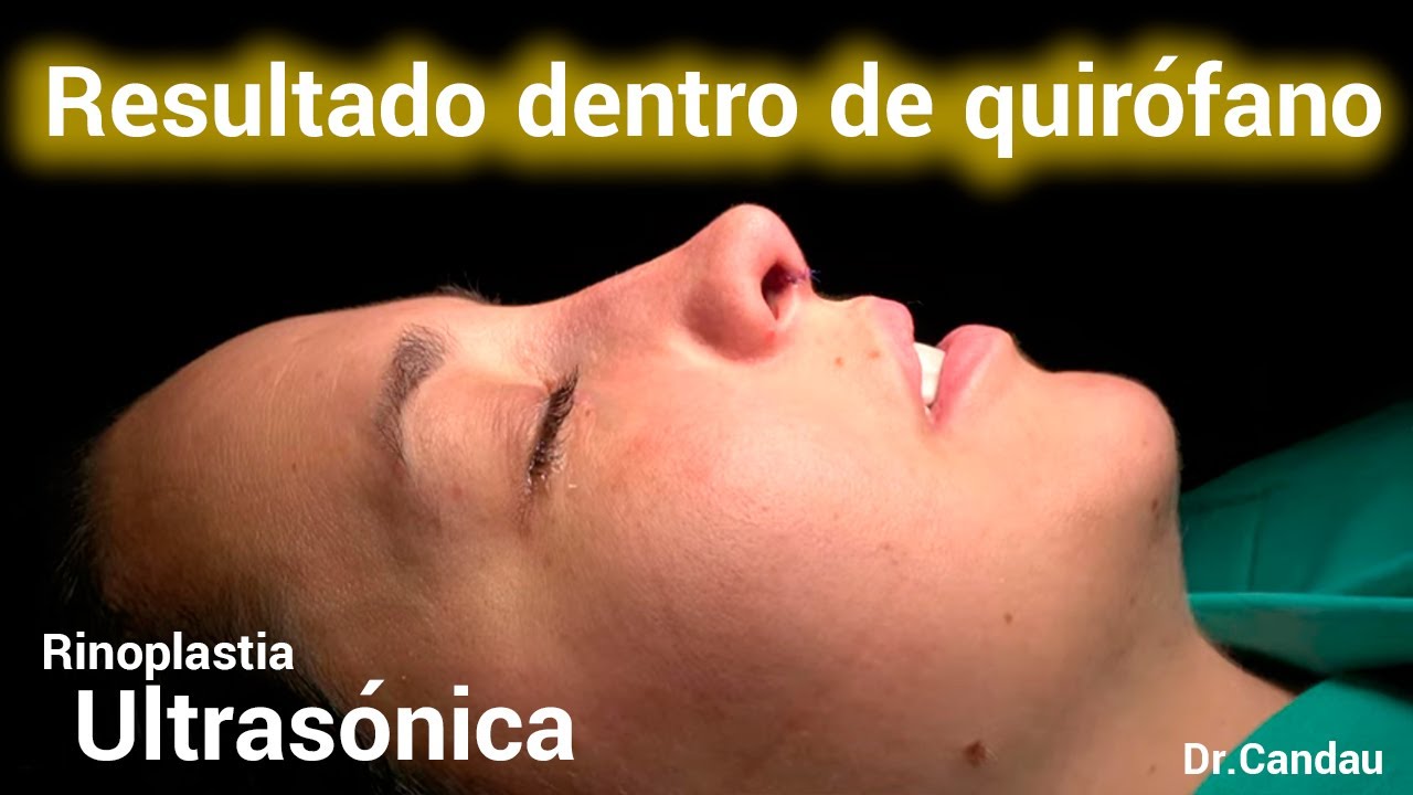Rinoplastia Ultrasónica: Experiencia de nuestra paciente